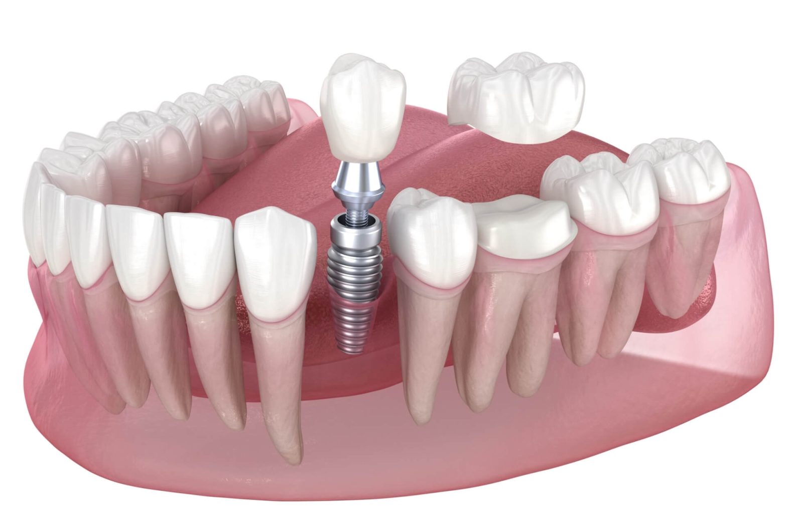 Dental implants vs veneers
