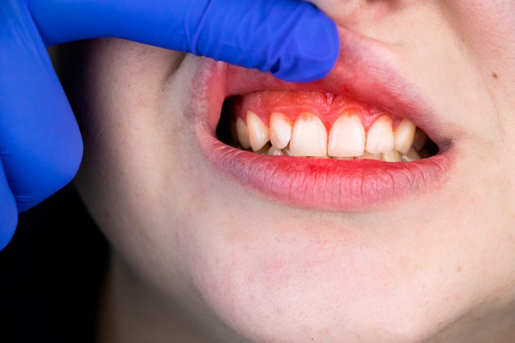Periodontist examine bleeding gums