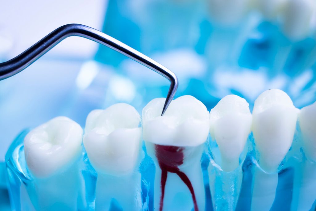 how long is root canal recovery