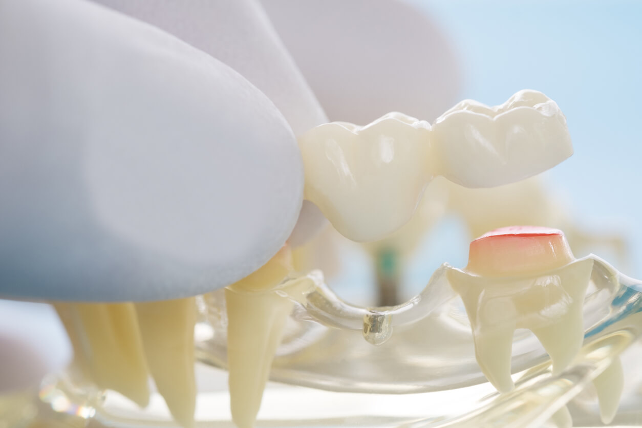 new dental bridge pain when chewing