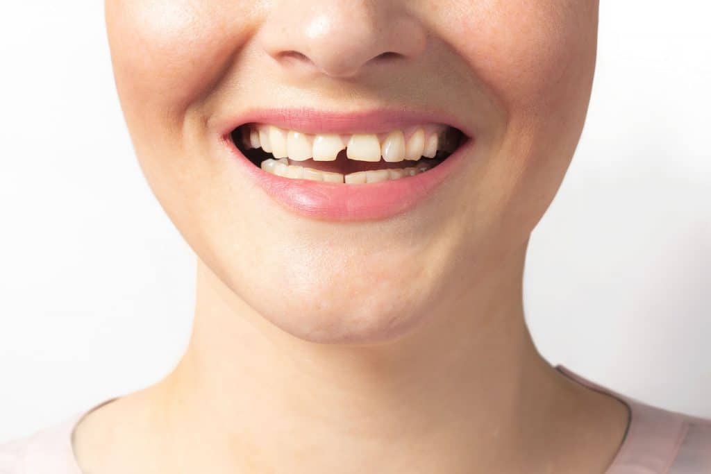 Woman shows broken tooth. Close up photo.