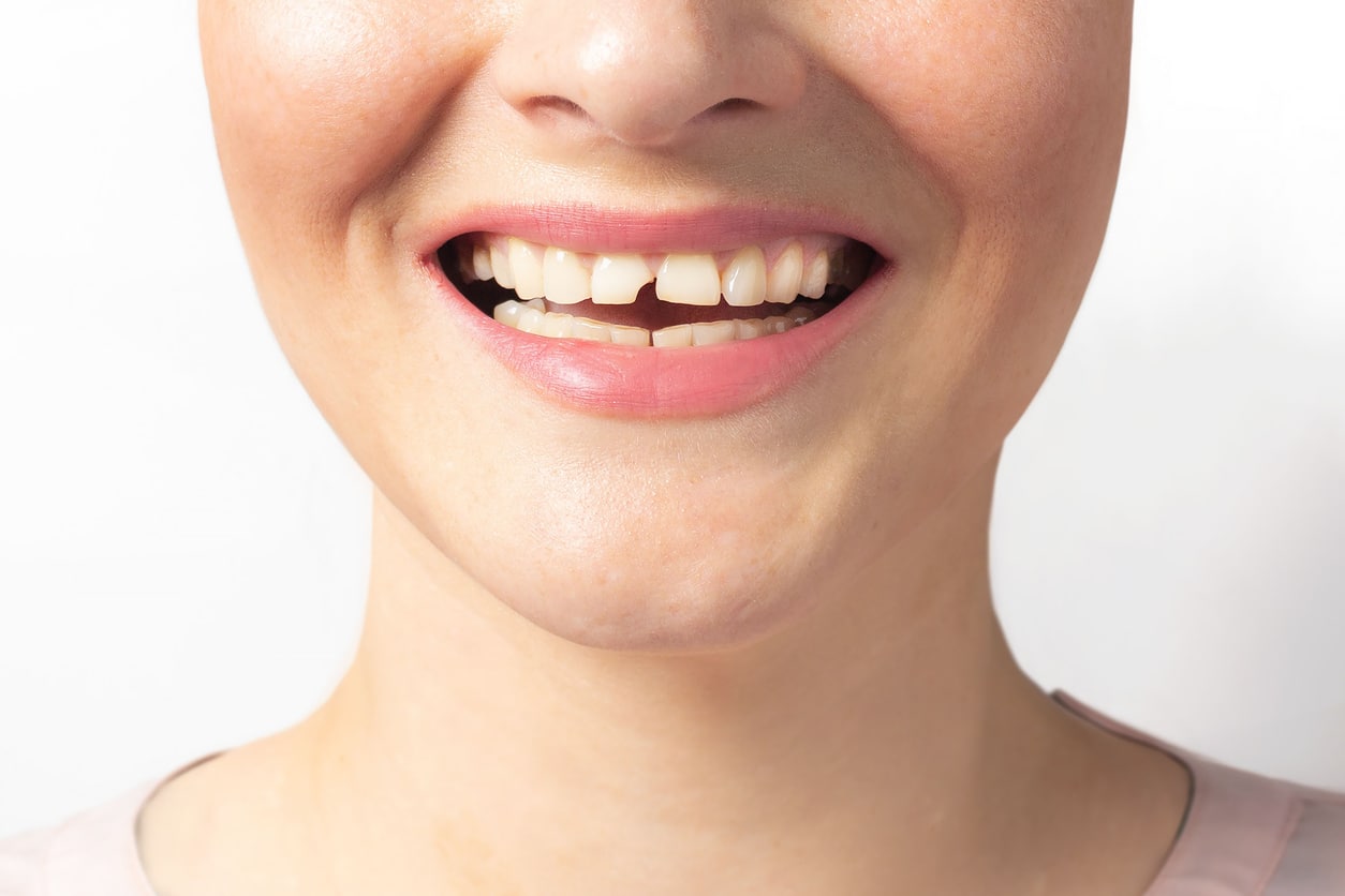 Woman shows broken tooth. Close up photo.