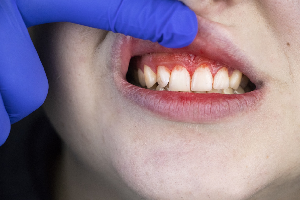 Gingivitis vs Periodontitis