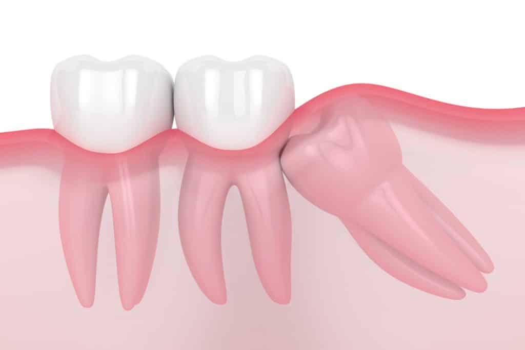Wisdom teeth impaction