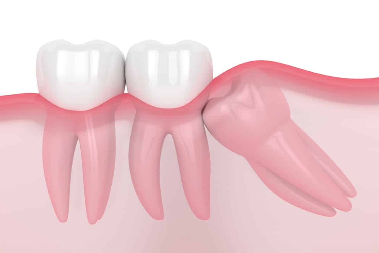 Wisdom teeth impaction