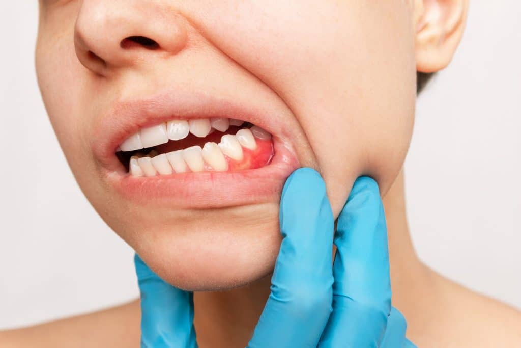 Periodontal Disease
