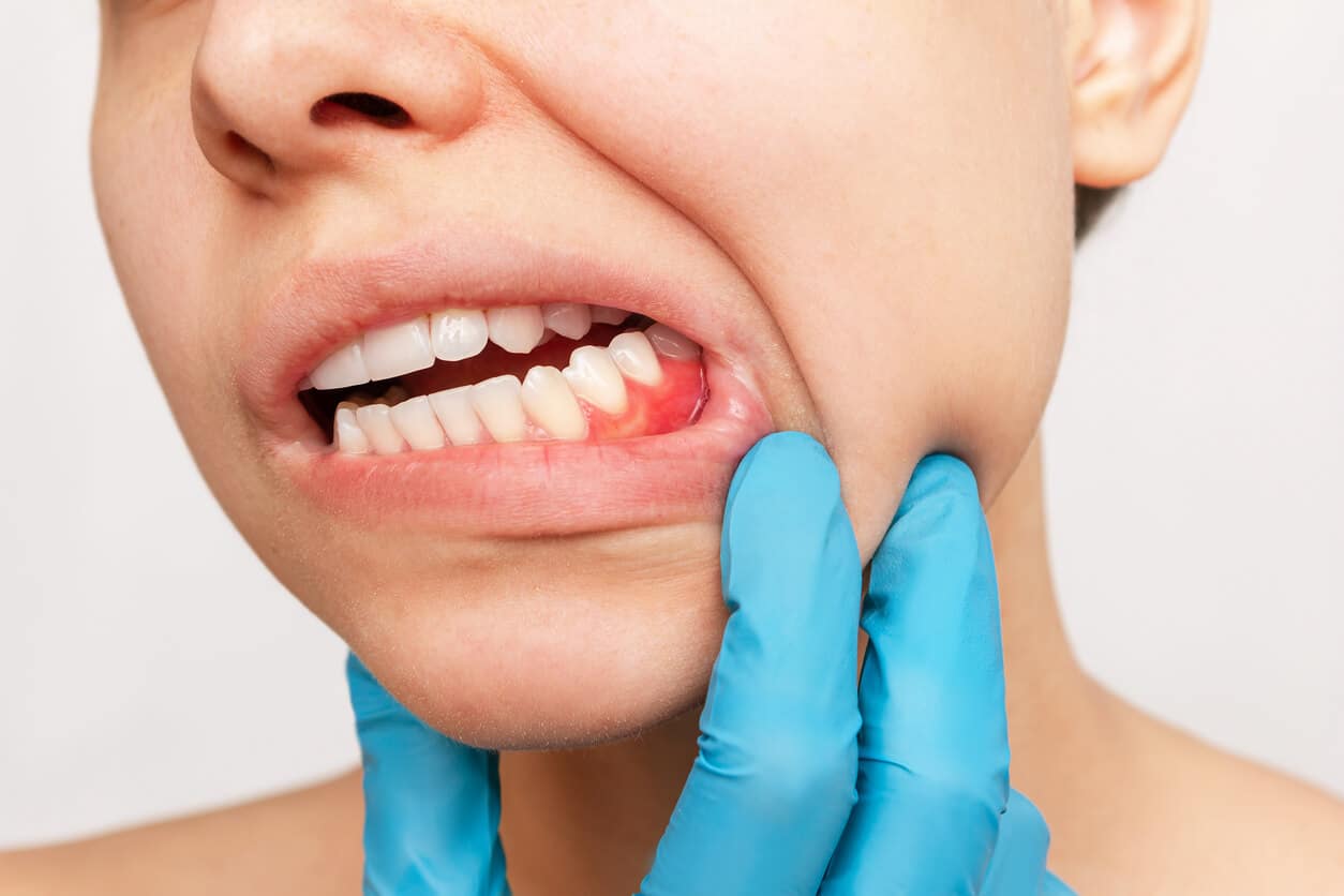 Periodontal Disease
